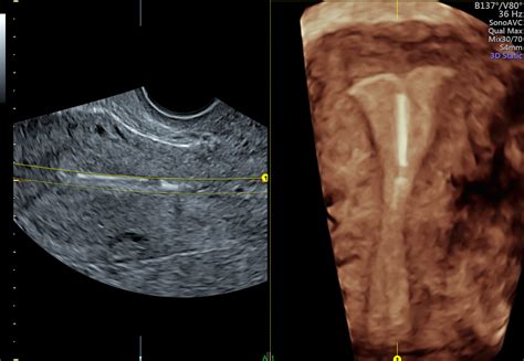 Assessing Malpositioned IUD Symptoms With 3D Ultrasound | Empowered Women's Health