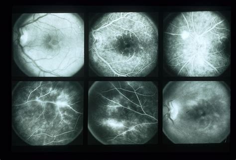 Eales Disease - Retina Image Bank