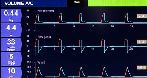 Mechanical ventilation I: Basic concepts – Critical Concepts