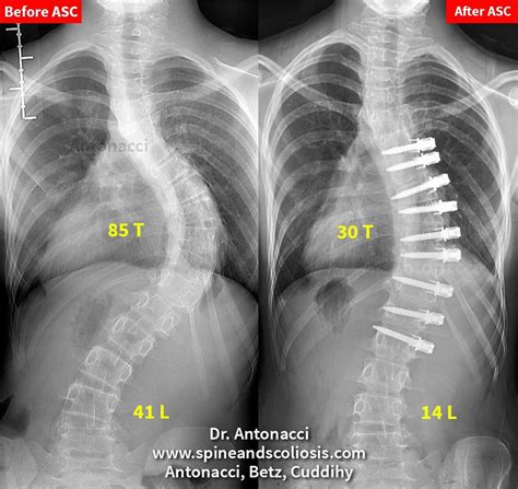 PM 12 Scoliosis Single Complex Curve from 85 Thoracic - Institute for ...