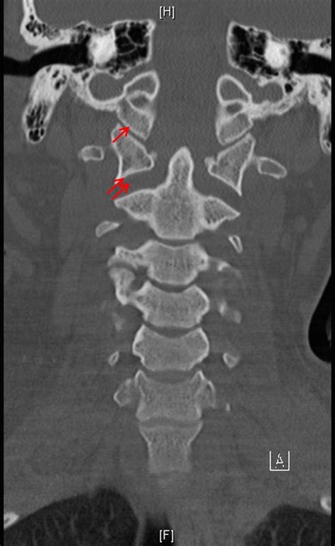 Cureus | Failure of the Condyle-C1 Interval Method to Diagnose Atlanto-occipital Dislocation in ...