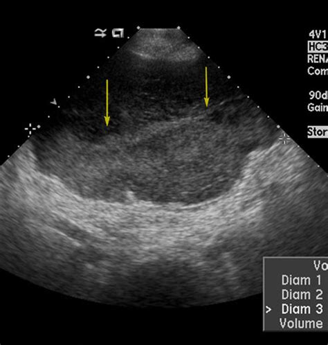 Male Pelvic Ultrasound