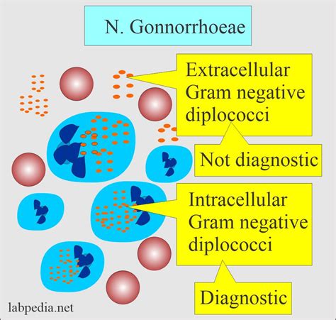 Gonorrhea, Diagnosis of Neisseria Gonorrhoeae - Labpedia.net