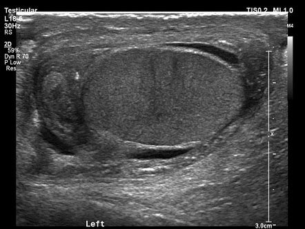 Torsion of the hydatid of Morgagni / testicular appendix | Radiology Case | Radiopaedia.org