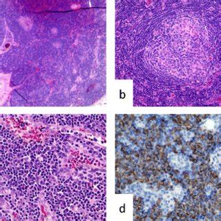 Pathological findings of the cervical lymph node biopsy. a Lymph node ...