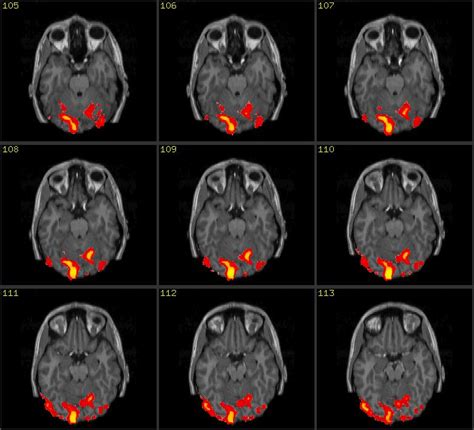 Brain Scanning of Pain » Center for Musculoskeletal Pain Research ...