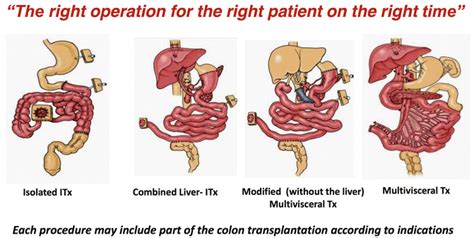 Chronic Intestinal Pseudo-obstruction Syndrome: Surgical Approach and ...