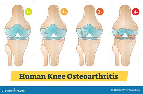 Knee Osteoarthritis Stages Cartoon Vector | CartoonDealer.com #238172023