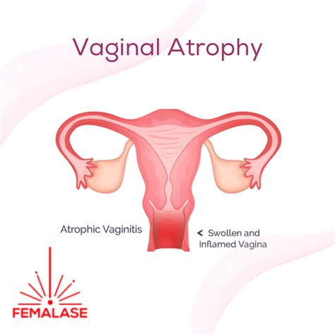 Understanding Vaginal Atrophy - Femalase