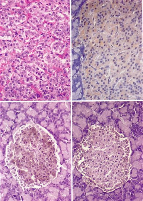 Islet cell tumor with positive insulin immunoreactivity. Anti-insulin ...