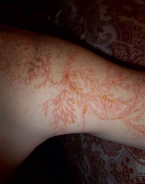 Lichtenberg Figure. Human Skin Struck by Lightning - Barnorama