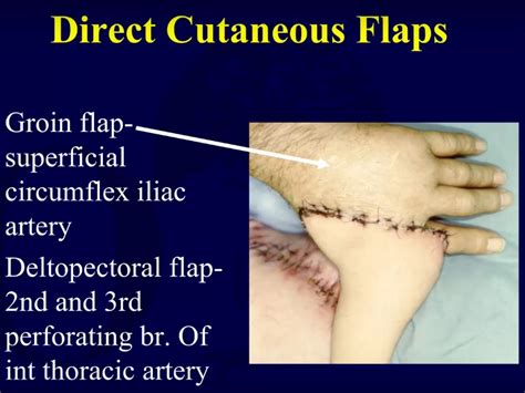 Wound coverage Techniques: Flaps — OrthopaedicPrinciples.com