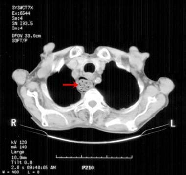 Zenker Diverticulum Imaging: Practice Essentials, Radiography, Computed ...