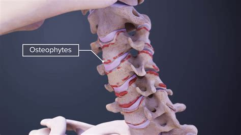 Cervical Bone Spurs Symptoms and Causes Animation | Spine-health