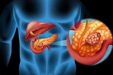 Best Pancreatic cancer surgery in Sarjapur Road, Bangalore | Best Pancreatic cancer treatment in ...