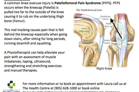 Patellofemoral Pain Syndrome (PFPS)