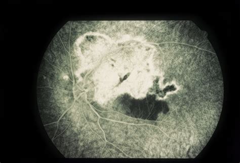 Paracentral Blind Spot And Scotoma - Retina Image Bank