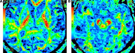 Fractional anisotropy map of a patient with left sided weakness: (A) at... | Download Scientific ...