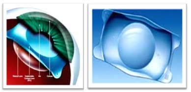 PHAKIC IOL SURGERY - Anil Eye Care Hospital