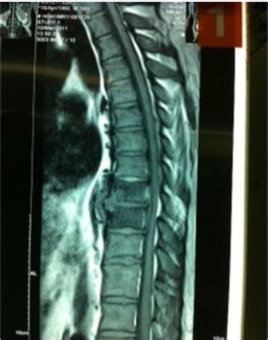 MRI paraspinal and intraspinal shows epidural abscess causing cord... | Download Scientific Diagram