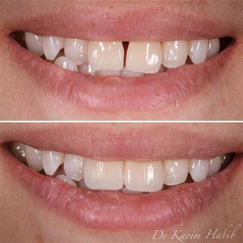 Composite Veneers Sydney | Dental Bonding Sydney - Dentist Ryde | Gladesville | Putney | North Ryde