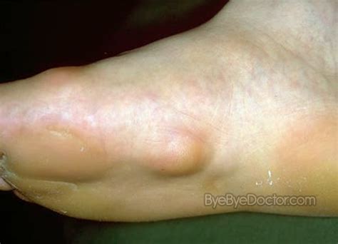 Plantar Fibromatosis – Symptoms, Causes, Pictures, Treatment ...