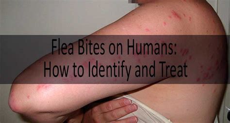 Flea bite on human: flea bites vs mosquito bites vs bed bug bites