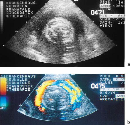 Umbilical Cord Complications and Doppler Ultrasound | Radiology Key