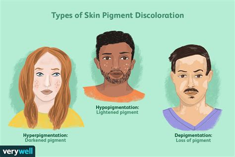 Skin Pigmentation: Genetics, Discoloration, and Treatment