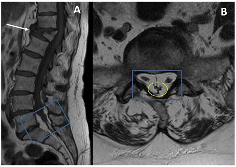 Epidural Lipomatosis Treatment - Infoupdate.org