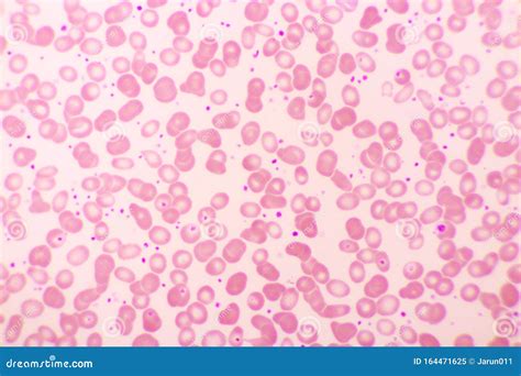 Essential Thrombocytosis Blood Smear Stock Image - Image of health ...