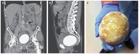 Neobladder Stone | NEJM