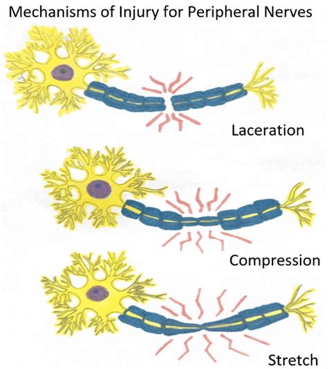 Classification of Peripheral Nerve Injury - Physiopedia