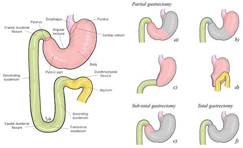 Partial Gastrectomy