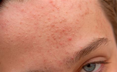 Comedones: what are they and how do I treat them? | MDacne