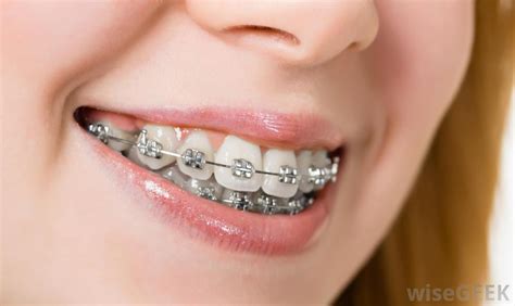 Teeth Alignment with Braces… – Dentist Downers Grove | General ...