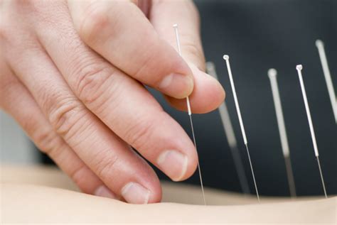 Acupuncture: All Natural Healing