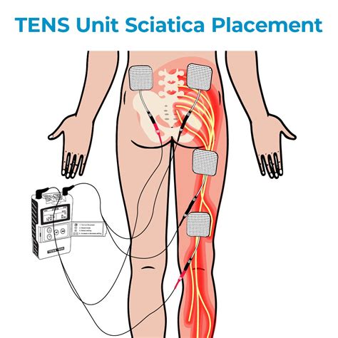 TENS Unit and Sciatica Pain Relief – TENS 7000