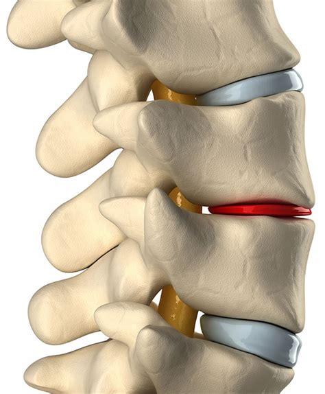 Degenerative Disc Disease Specialists in Schertz | BioMotion PT