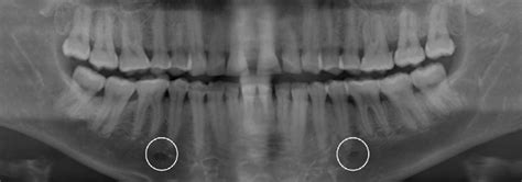 Radiographic Identification of Unilateral Accessory Mental Foramen | Dr ...