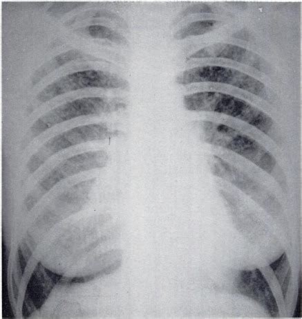 Eosinophilic Granuloma of the Lung - Diseases of the Chest