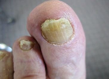 Generally Speaking What Does Melanoma Under A Toenail Look Like? - Blurtit