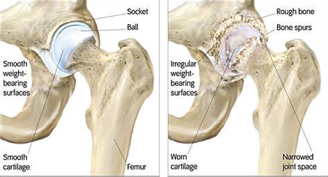 Osteoarthritis | the advancement of care for hip osteoarthritis is ...