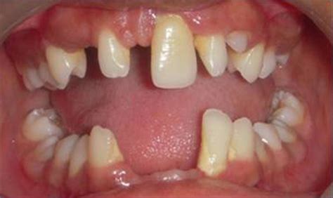 Dentin dysplasia type I | BMJ Case Reports