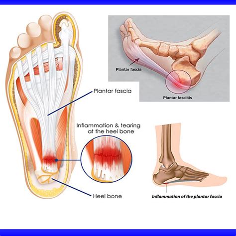 What is Plantar Fasciitis - How to Stretch / Balance Solutions PT