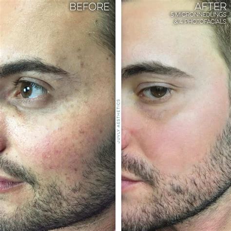 Juvly Aesthetics: IPL Photofacial Reverse Signs of Aging