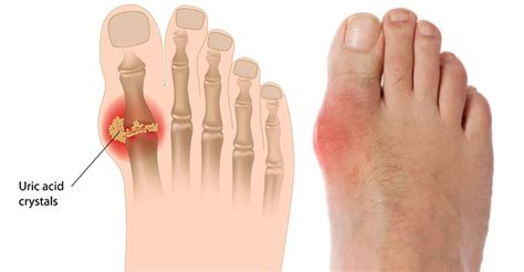 Gout | Dr. Alice Wang