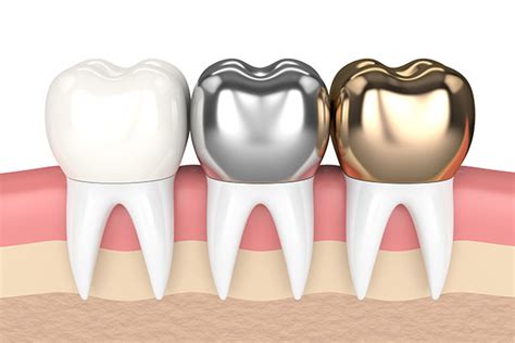 CEREC Crowns vs Traditional - Which Is Better, Bonded or Cemented in Place?