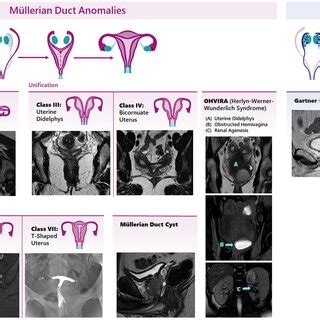 of Müllerian and Wolffian duct anomalies shown as representative... | Download Scientific Diagram