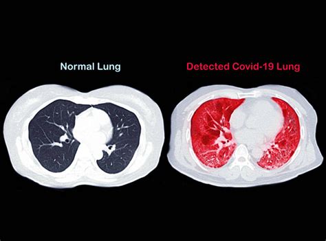 Normal And Covid19 Infected Lung Ct Scan Comparison Photo Background And Picture For Free ...